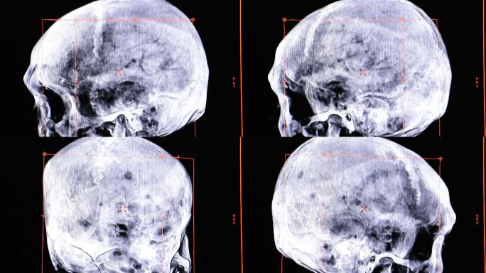 CT扫描机颅骨