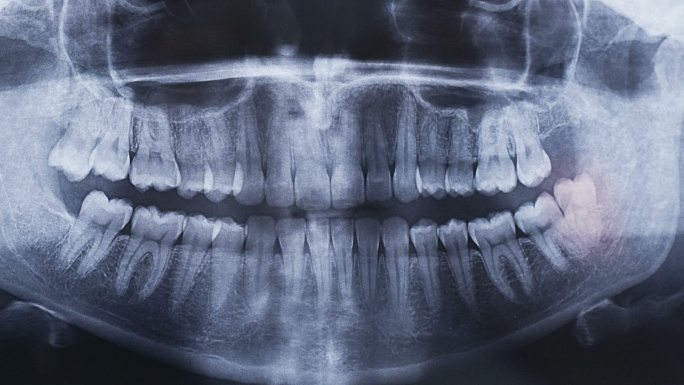 牙科全景X线图像医疗诊所医疗保健和医学