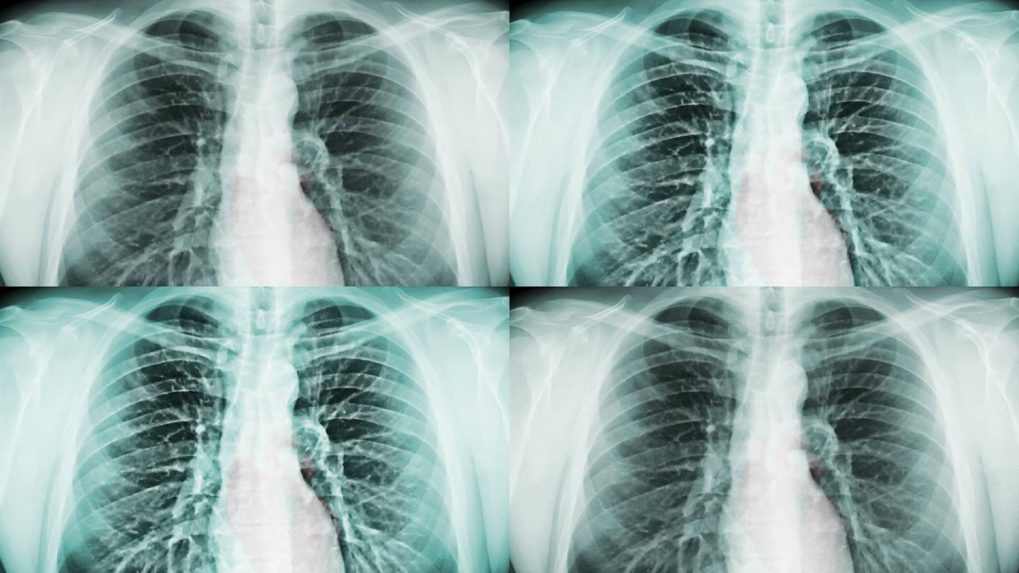 胸部x光和辐射吸气医疗保健和医学科学