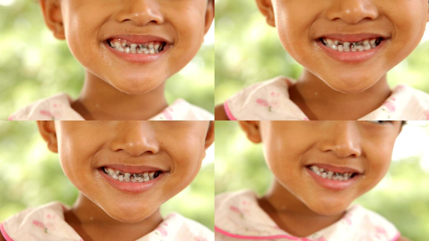长有蛀牙的小孩子儿童长蛀牙特写换牙齿乳牙