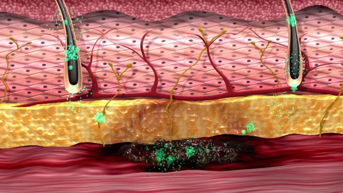 通过毛孔进入皮肤病灶