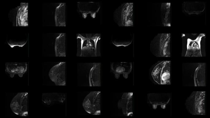 女性乳腺MRI扫描