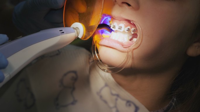 牙科医生用光敏聚合物灯检查牙齿