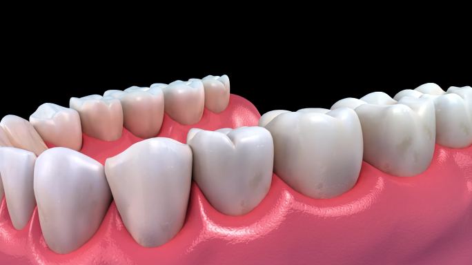 牙菌斑滋生3D动画