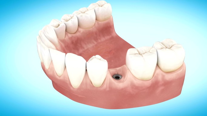 牙种植体安装动画陶瓷牙科贴面健康生活方式