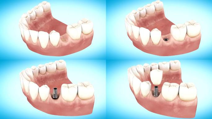 牙种植体安装动画陶瓷牙科贴面健康生活方式