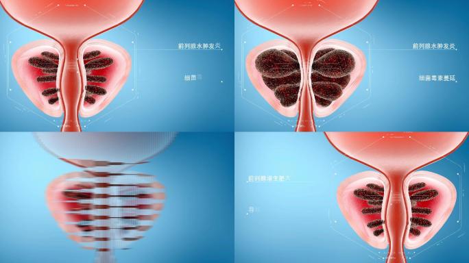 前列腺水肿增生肥大