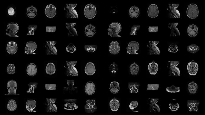 人脑磁共振扫描