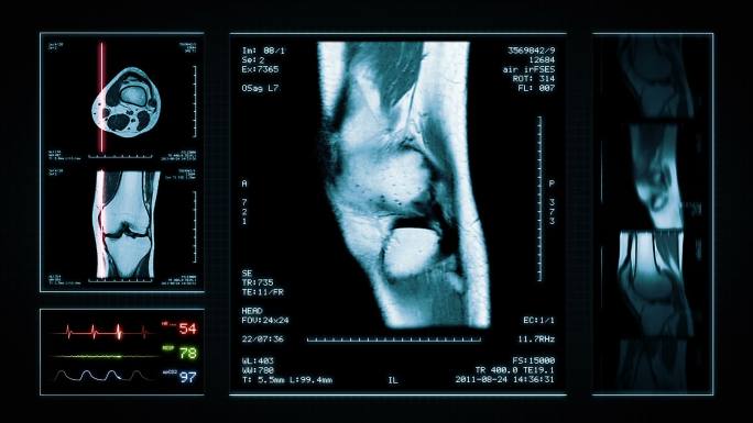 膝关节核磁共振扫描图像