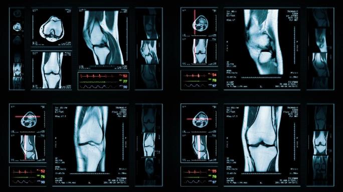 膝关节核磁共振扫描图像