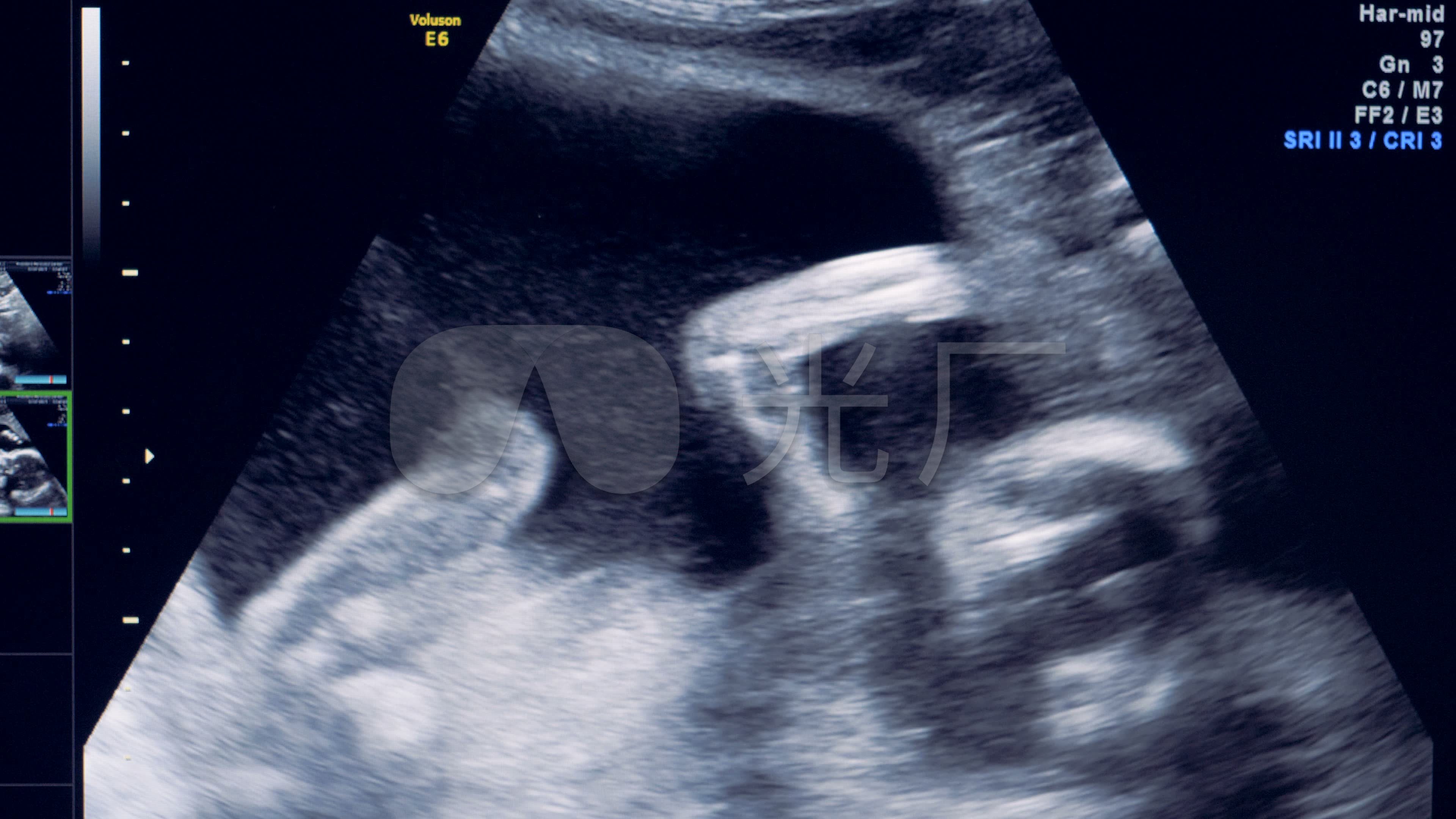 严重缺氧胎心监护图解（孕后期做胎心监护，如何看宝宝是否缺氧？有些知识孕妈该懂） | 说明书网