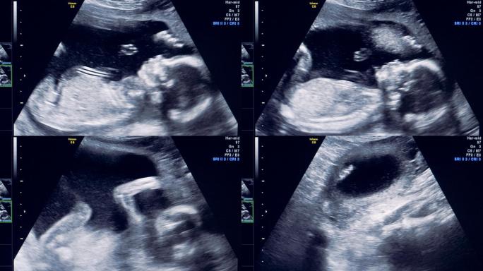 婴儿b超胎监生育孕妇
