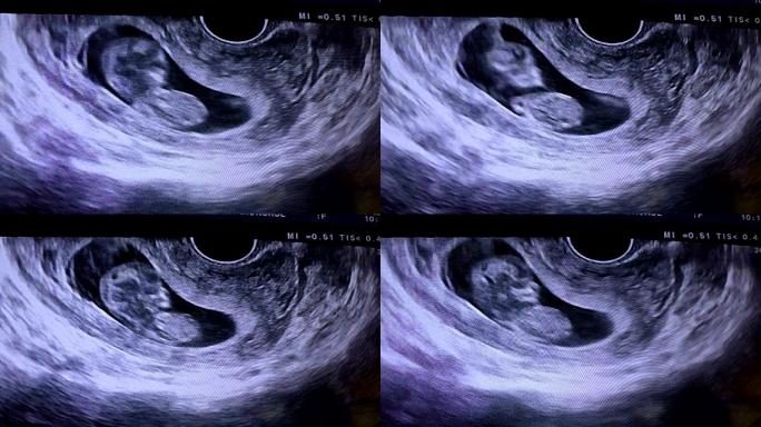 妊娠超声检查