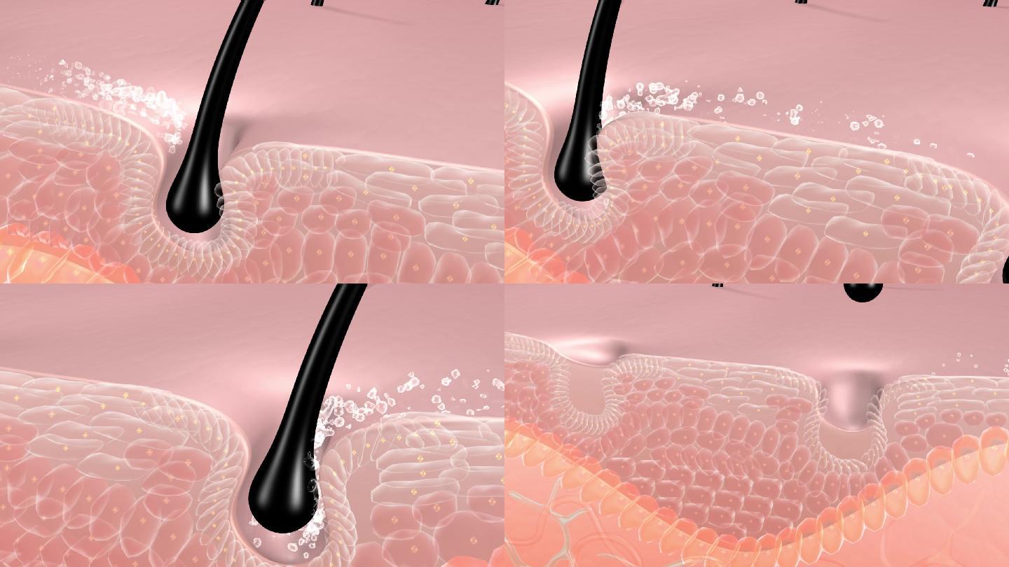 脱毛液使毛囊毛发脱落