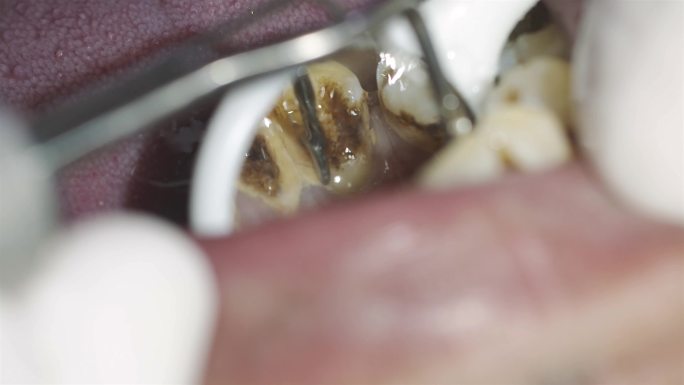 口腔医院清除牙结石超声波洗牙4K