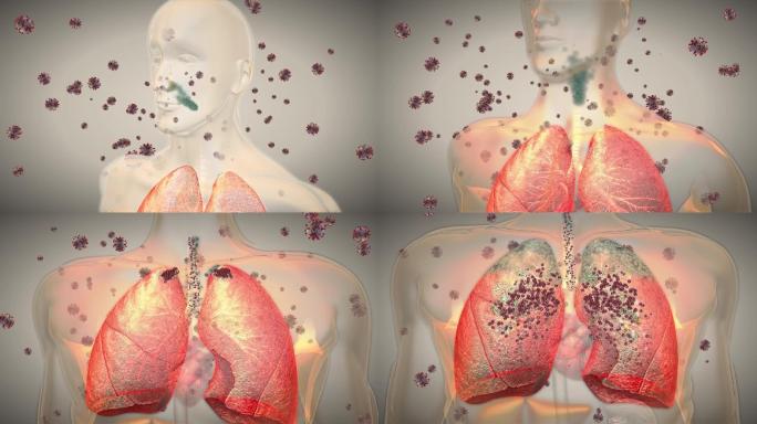 病毒通过呼吸道进入肺部快速增殖形成肺炎