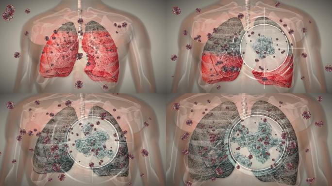 肺脏感染新冠病毒并扩散沉积