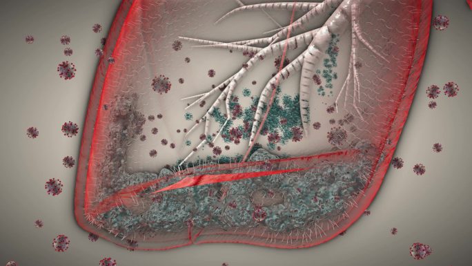 特写夸张双肺感染新冠病毒并扩散沉积