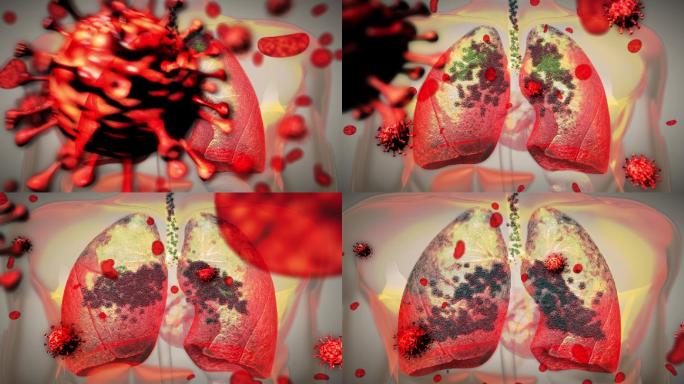 新冠病毒顺着呼吸道扩散感染肺部深处并堆积