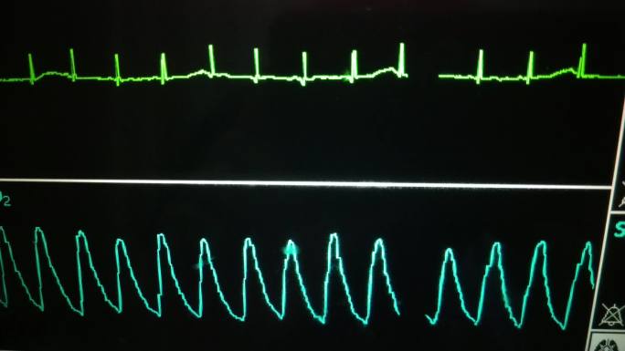 医院心律监护仪
