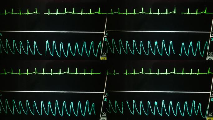 医院心律监护仪