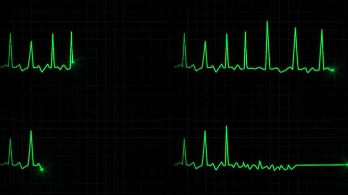 原创4K心电图停止心跳视频素材