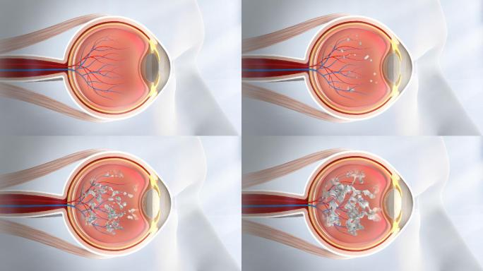 人体眼部 眼病 白内障 玻璃体混浊