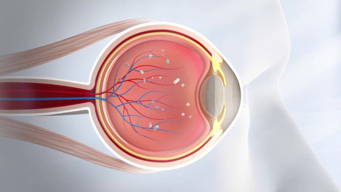 眼部垃圾堆积 白内障 玻璃体混浊