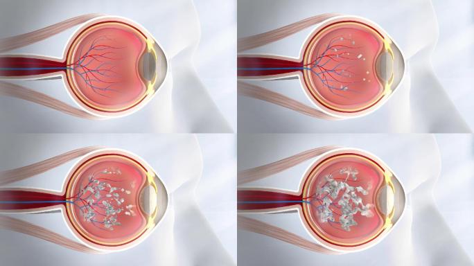 眼部垃圾堆积 白内障 玻璃体混浊