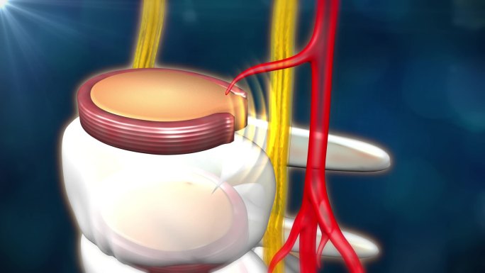 修复髓核骨刺压迫椎间盘纤维环重新连接
