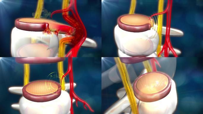 修复髓核骨刺压迫椎间盘纤维环重新连接