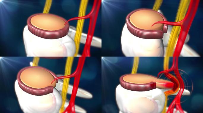 椎间盘纤维环破裂导致髓核突出压迫神经血管