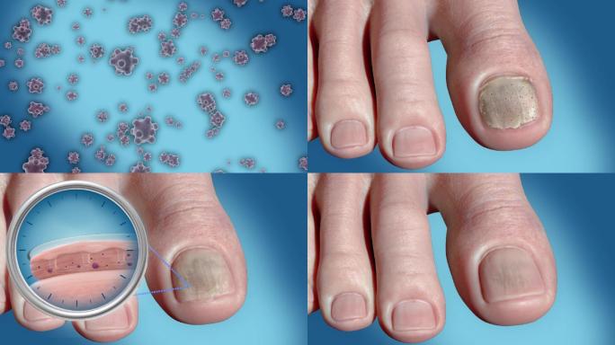 灰指甲 脚  细菌