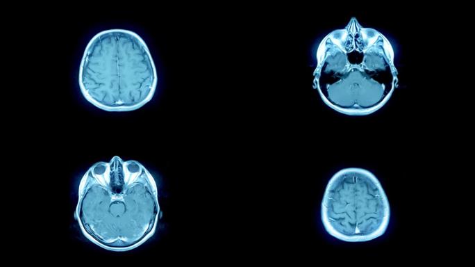 脑MRI扫描生物医学插图MRI扫描额叶