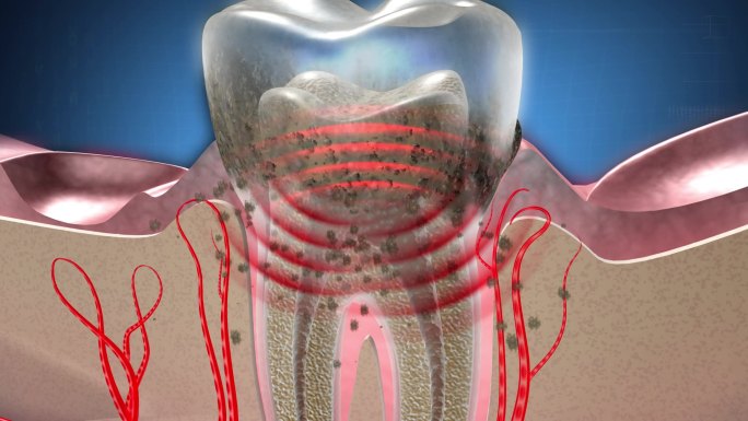牙菌斑中细菌破坏牙组织，牙结石引起炎症2