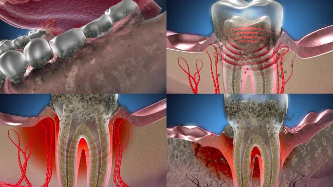 牙菌斑中细菌破坏牙组织，牙结石引起炎症2