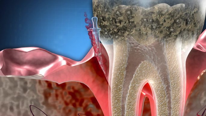 牙菌斑、牙结石是造成牙龈反复出血的原因