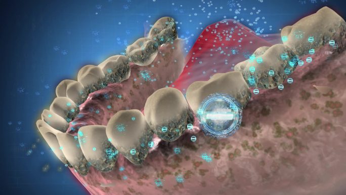 咀嚼片产生负电荷微粒吸附清除牙菌斑牙结石