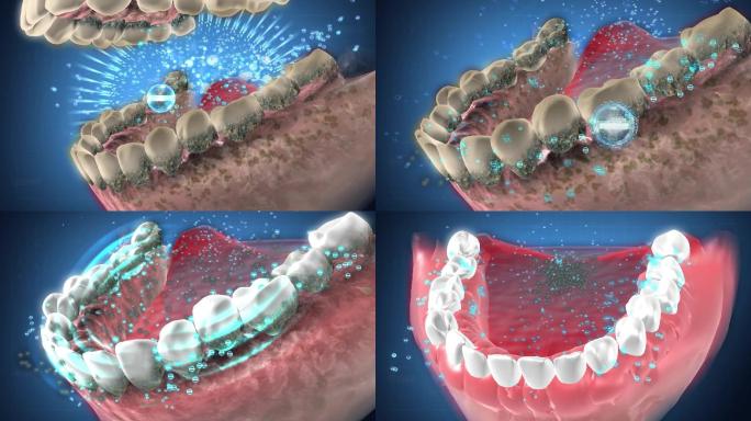 咀嚼片产生负电荷微粒吸附清除牙菌斑牙结石