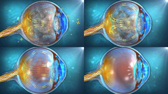将受损的玻璃体、晶状体修复至健康状态