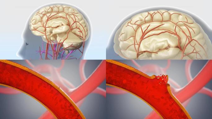 大脑血管破裂血小板漏出三维动画视频