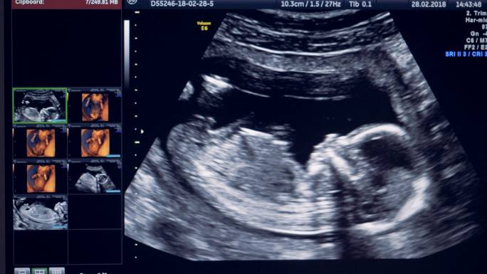 超声波监视器上显示一个小婴儿
