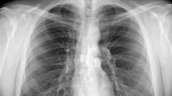 胸部x光胸片医疗检查看病