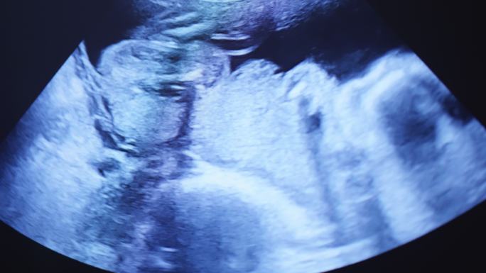 妊娠超声检查彩超B超胚胎体检孕妇发育
