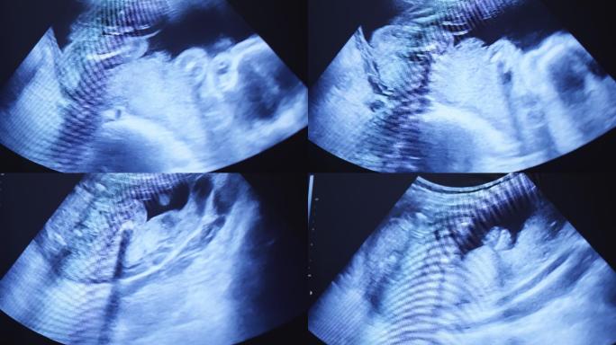 妊娠超声检查彩超B超胚胎体检孕妇发育