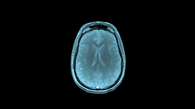 人脑MRI扫描医疗和医学医学考试运动图像