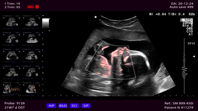 妊娠中期的超声波检查