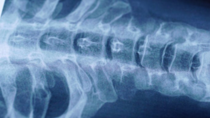颈椎X线片医学X射线检查人体脊柱