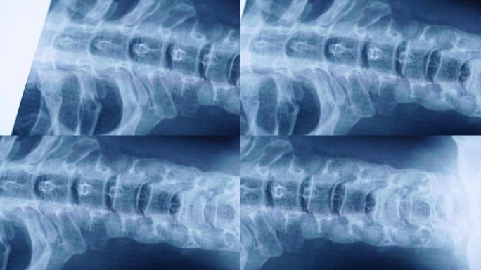 颈椎X线片医学X射线检查人体脊柱