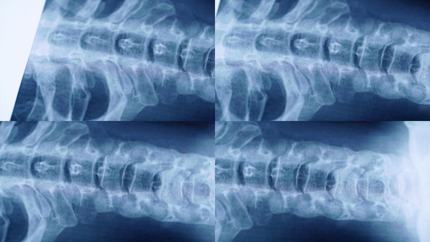 颈椎X线片医学X射线检查人体脊柱